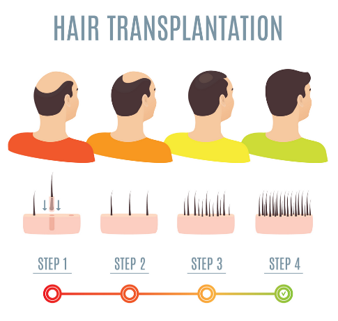 Hair Transplant